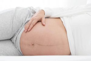 Zwangerschapslijn