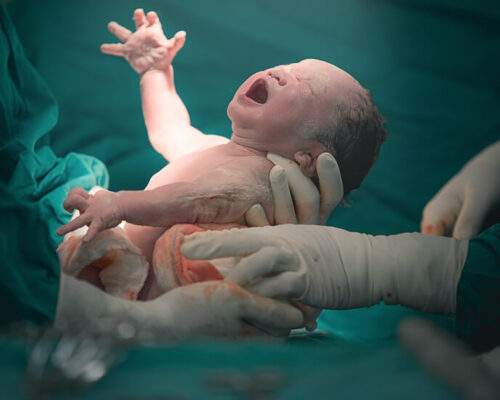 De moeder-geassisteerde keizersnede; zelf je baby ter wereld brengen
