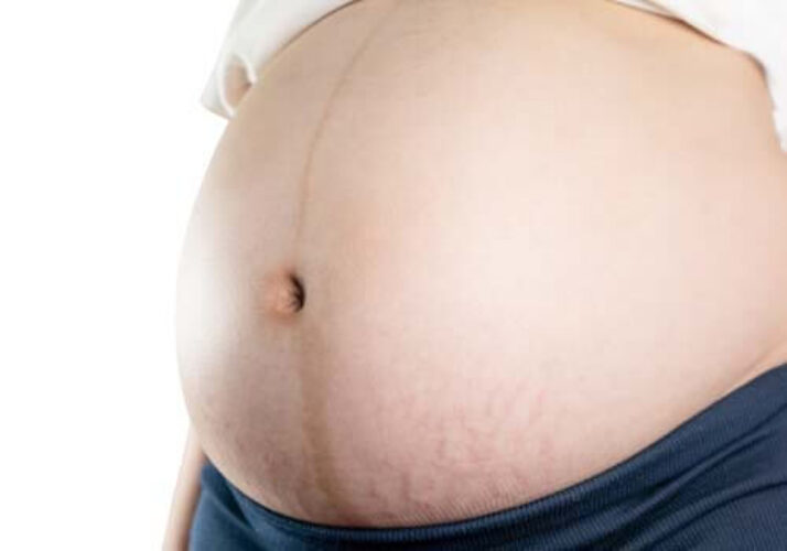 Linea nigra - zwangerschapsstreep buik