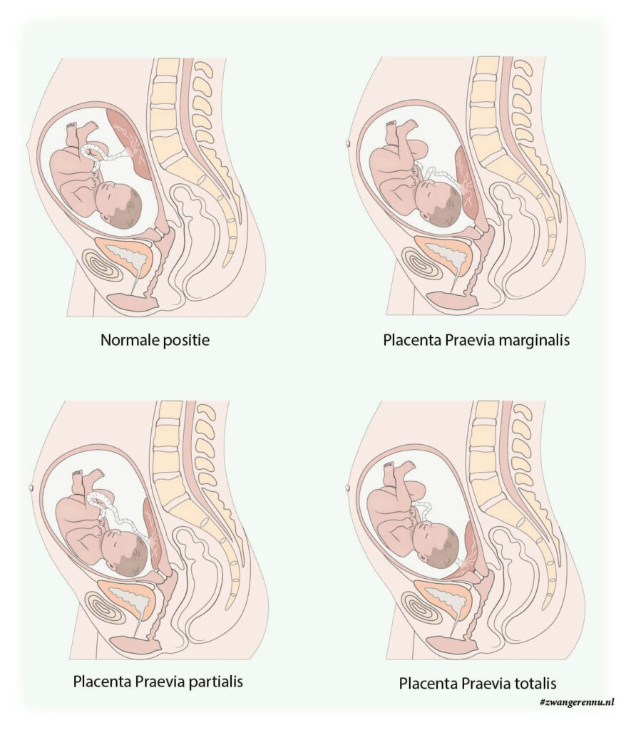 Placenta Praevia