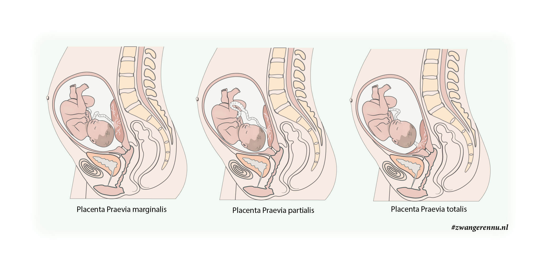 Placenta Preavia liggingen