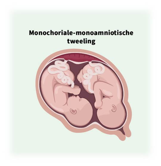 Monochoriale-monoamniotische tweeling