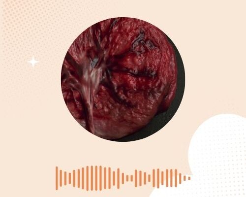 Velamenteuze insertie: Wat betekent dit voor je zwangerschap?