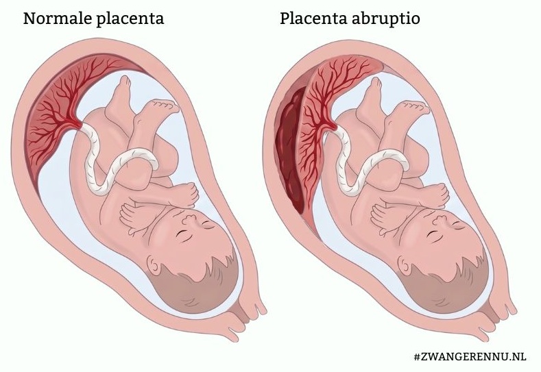 placenta loslating