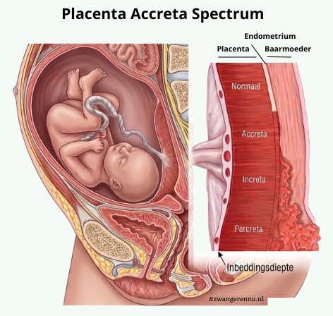 placenta-accreta